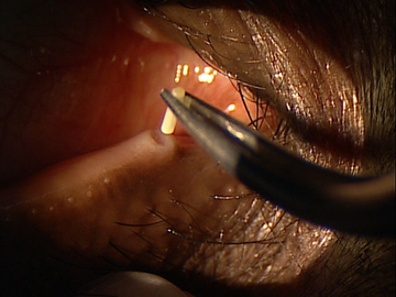 Lacrimal Punctum