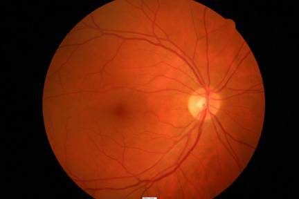 Healthy retina web